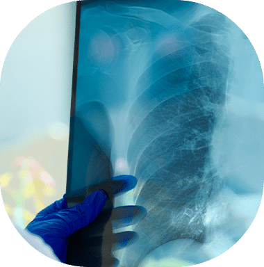 Foto DPOC e enfisema